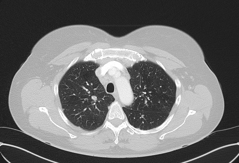 Cardiac sarcoidosis (Radiopaedia 74548-85534 Axial lung window 21).jpg