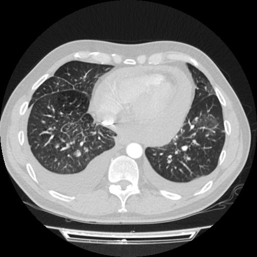 Cardiac tamponade (Radiopaedia 78607-91368 Axial lung window 65).jpg