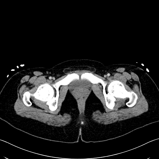 File:Caroli disease with medullary sponge kidney (Radiopaedia 82622-96804 C 76).jpg