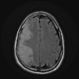 File:Carotid arterial dissection with acute cerebral infarction (Radiopaedia 26636-26784 Axial FLAIR 16).jpg