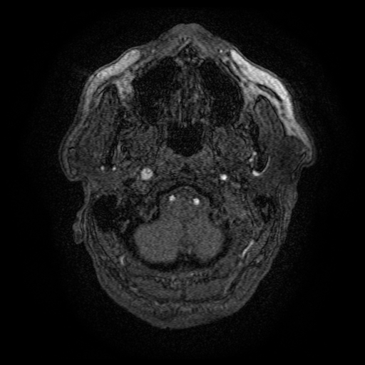 Carotid arterial dissection with acute cerebral infarction (Radiopaedia 26636-26784 MRA 167).jpg