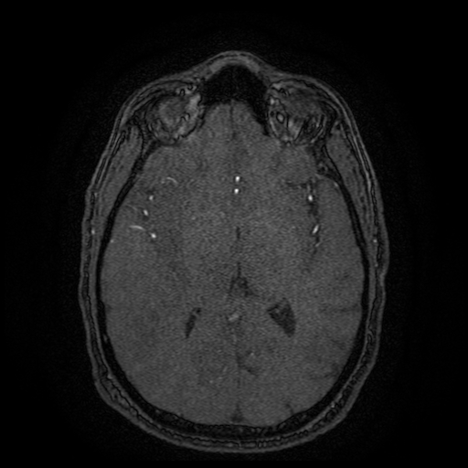 Carotid arterial dissection with acute cerebral infarction (Radiopaedia 26636-26784 MRA 77).jpg