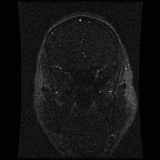 Carotid arterial dissection with acute cerebral infarction (Radiopaedia 26636-26784 MRV 118).jpg