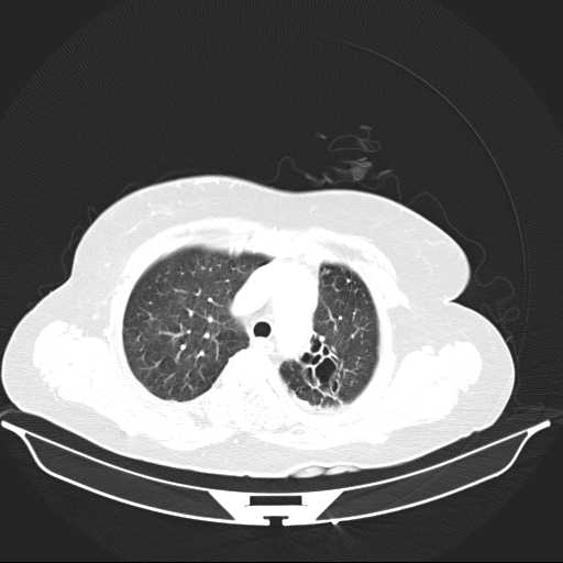 File:Carotid body tumor (Radiopaedia 21021-20948 Axial lung window 7).jpg