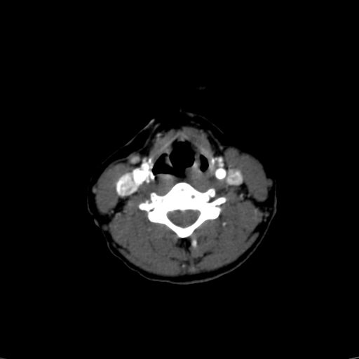 File:Carotid body tumor (Radiopaedia 39845-42300 B 19).jpg