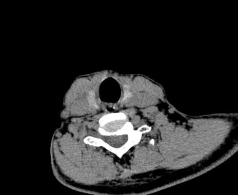 File:Carotid body tumor (Radiopaedia 61750-69757 Axial non-contrast 84).jpg