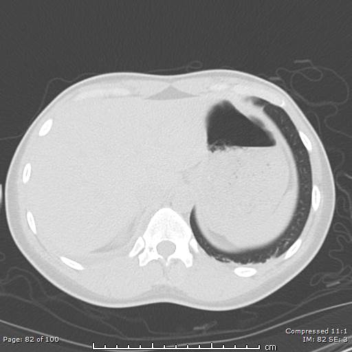 Catamenial pneumothorax (Radiopaedia 54382-60600 Axial non-contrast 82).jpg
