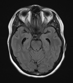 File:Cavernoma with bleed - midbrain (Radiopaedia 54546-60774 Axial FLAIR 12).png