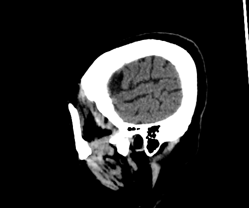 Cavernous hemangioma of the cerebellar falx (Radiopaedia 73025-83723 B 287).jpg