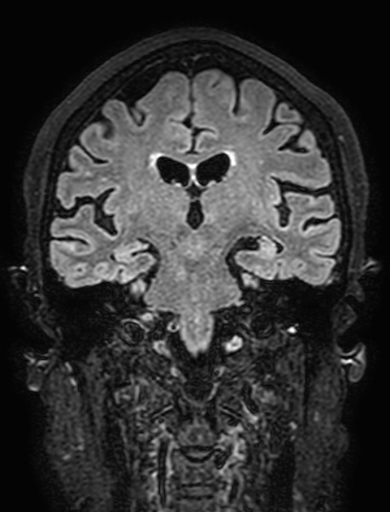 Cavernous hemangioma of the cerebellar falx (Radiopaedia 73025-83724 Coronal FLAIR 192).jpg
