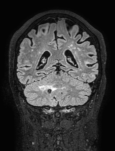 Cavernous hemangioma of the cerebellar falx (Radiopaedia 73025-83724 Coronal FLAIR 245).jpg