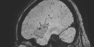 Cavernous hemangioma of the cerebellar falx (Radiopaedia 73025-83724 Sagittal BOLD 167).jpg