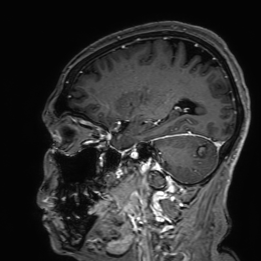 Cavernous hemangioma of the cerebellar falx (Radiopaedia 73025-83724 Sagittal T1 C+ 69).jpg