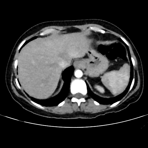 File:Cavitating lung mass - squamous cell carcinoma (Radiopaedia 48047-52854 B 40).png
