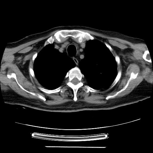 Cavitating pulmonary metastases (Radiopaedia 89545-106544 Axial non-contrast 9).jpg