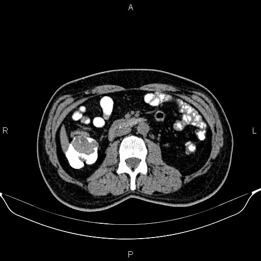 Cecal adenocarcinoma (Radiopaedia 85324-100916 Axial non-contrast 45).jpg