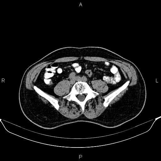 File:Cecal adenocarcinoma (Radiopaedia 85324-100916 Axial non-contrast 63).jpg