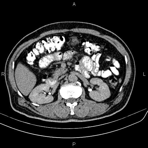 File:Cecal cancer with appendiceal mucocele (Radiopaedia 91080-108651 Axial C+ delayed 21).jpg