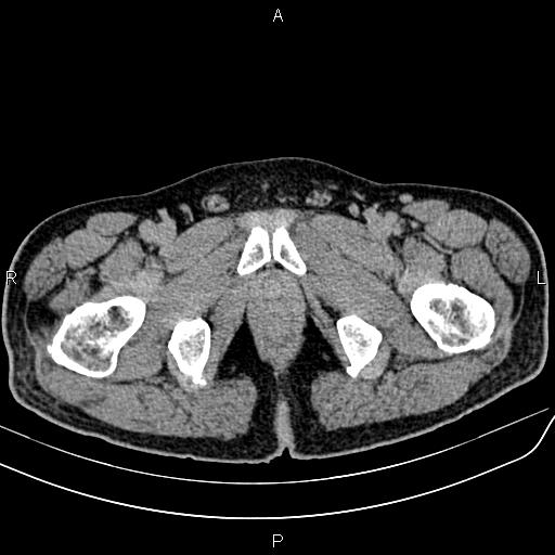 File:Cecal cancer with appendiceal mucocele (Radiopaedia 91080-108651 Axial C+ delayed 89).jpg