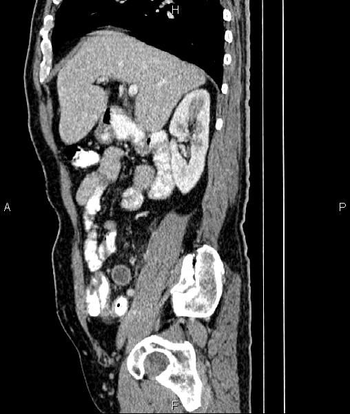 File:Cecal cancer with appendiceal mucocele (Radiopaedia 91080-108651 E 32).jpg