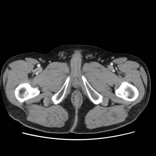 Cecal mass causing appendicitis (Radiopaedia 59207-66531 A 96).jpg