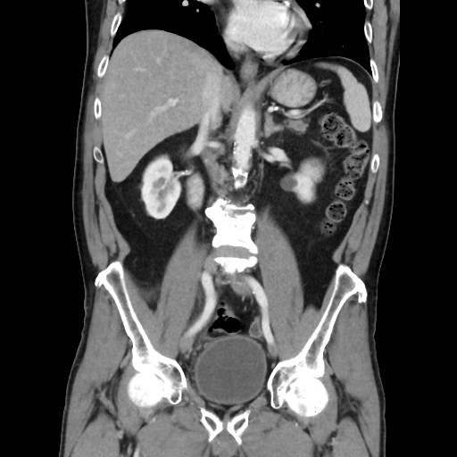 Cecal mass causing appendicitis (Radiopaedia 59207-66531 B 28).jpg