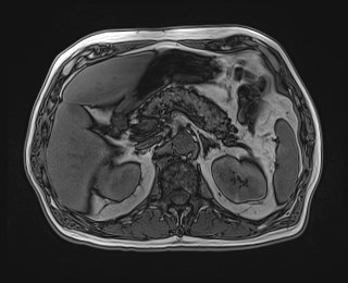 Cecal mass causing appendicitis (Radiopaedia 59207-66532 D 46).jpg
