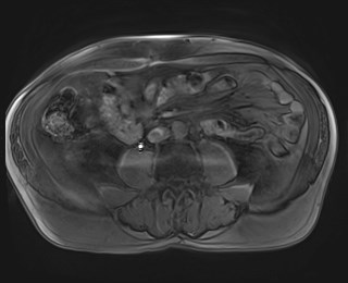 Cecal mass causing appendicitis (Radiopaedia 59207-66532 K 79).jpg