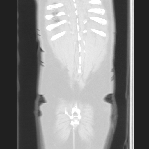 Cecal volvulus (Radiopaedia 75378-86620 Coronal lung window 122).jpg