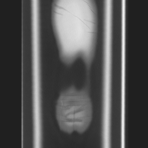 Cecal volvulus (Radiopaedia 75378-86620 Coronal lung window 132).jpg