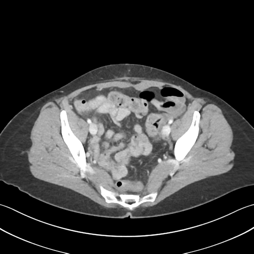 Cecum hernia through the foramen of Winslow (Radiopaedia 46634-51112 A 60).png