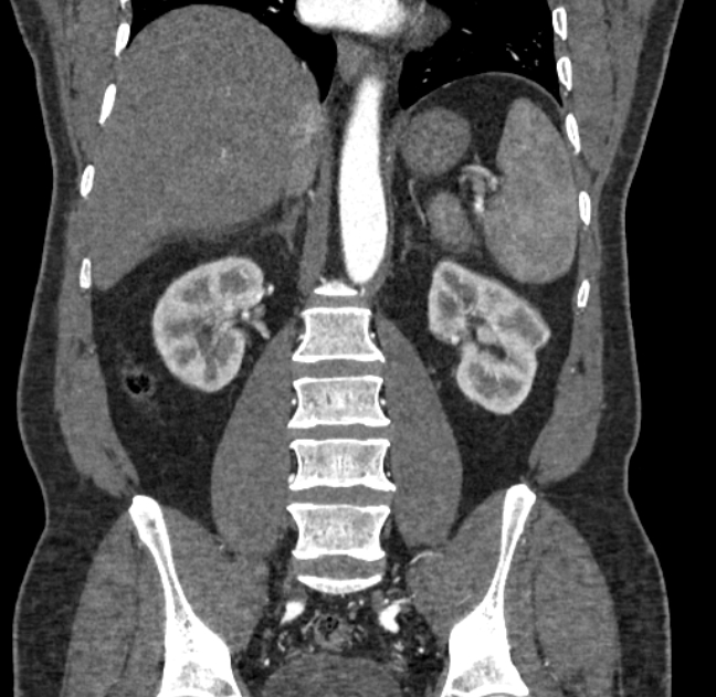 Celiac artery dissection (Radiopaedia 52194-58080 C 92).jpg