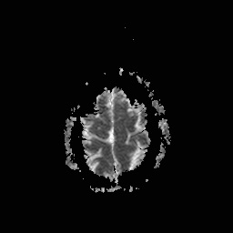 File:Central-variant posterior reversible encephalopathy syndrome (PRES) (Radiopaedia 43880-47358 Axial ADC 21).jpg