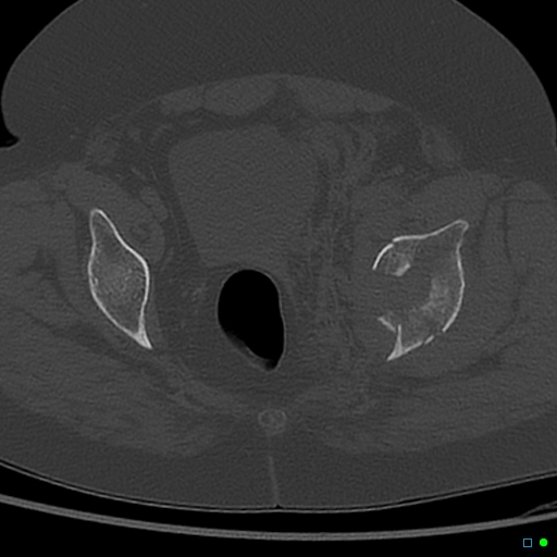 Central fracture-dislocation of the acetabulum (Radiopaedia 36578-38150 Axial bone window 51).jpg