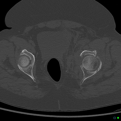 Central fracture-dislocation of the acetabulum (Radiopaedia 36578-38150 Axial bone window 57).jpg