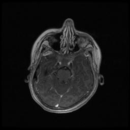 Central neurocytoma (Radiopaedia 30220-30842 Axial T1 C+ 47).jpg