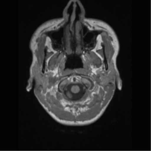 File:Central neurocytoma (Radiopaedia 37664-39557 Axial T1 3).png