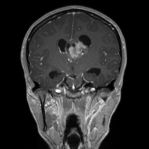 Central neurocytoma (Radiopaedia 37664-39557 Coronal T1 C+ 45).png