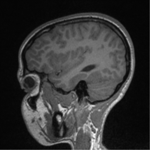 Central neurocytoma (Radiopaedia 37664-39557 Sagittal T1 72).png