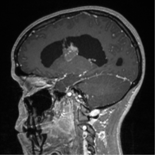 Central neurocytoma (Radiopaedia 37664-39557 Sagittal T1 C+ 39).png