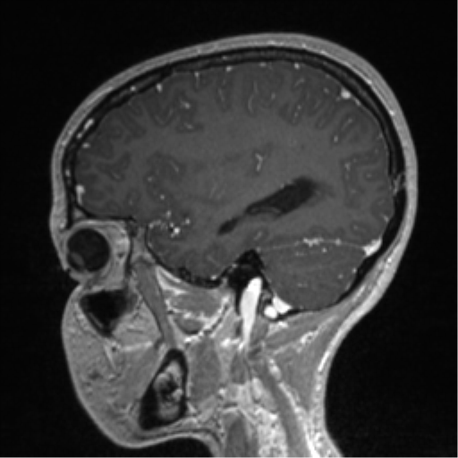 Central neurocytoma (Radiopaedia 37664-39557 Sagittal T1 C+ 70).png