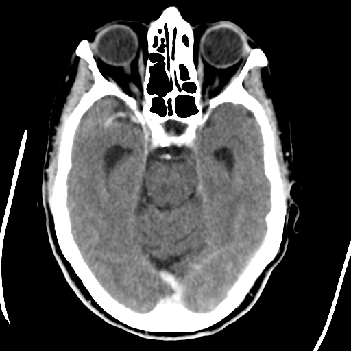 Central neurocytoma (Radiopaedia 65317-74346 Axial C+ delayed 18).png