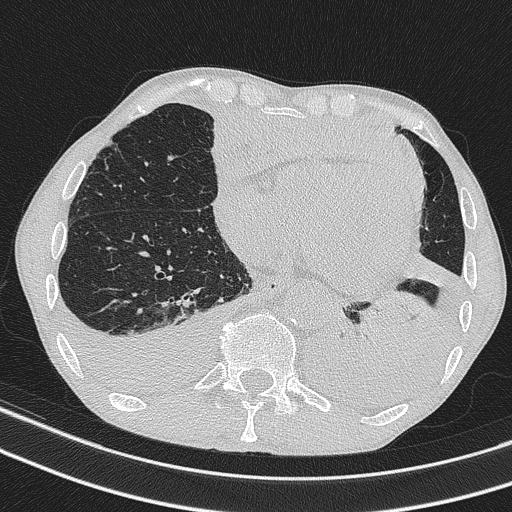File:Central venous catheter tip extravasation (Radiopaedia 82828-97113 Axial lung window 62).jpg