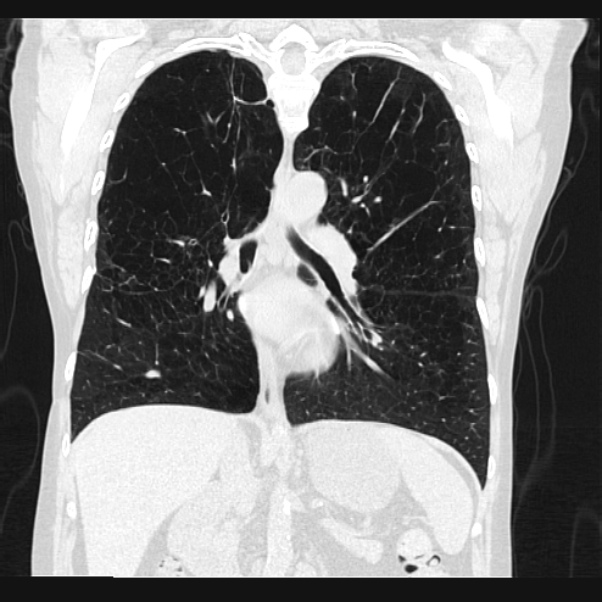 Centrilobular pulmonary emphysema (Radiopaedia 24495-24789 Coronal lung window 42).jpg