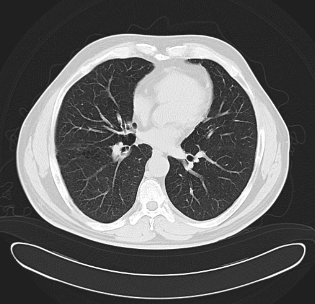 Centrilobular pulmonary emphysema (Radiopaedia 26808-26971 C 26).jpg