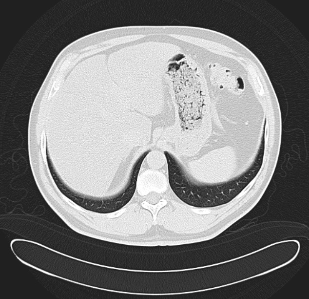 Centrilobular pulmonary emphysema (Radiopaedia 26808-26971 C 41).jpg