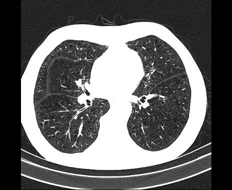 Centrilobular pulmonary emphysema (Radiopaedia 62468-70718 Axial lung window 44).jpg
