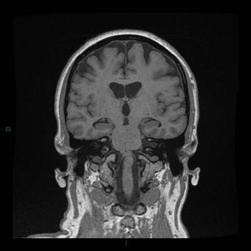 Cerebellar abscess (Radiopaedia 78135-90678 Coronal T1 C+ 85).jpg
