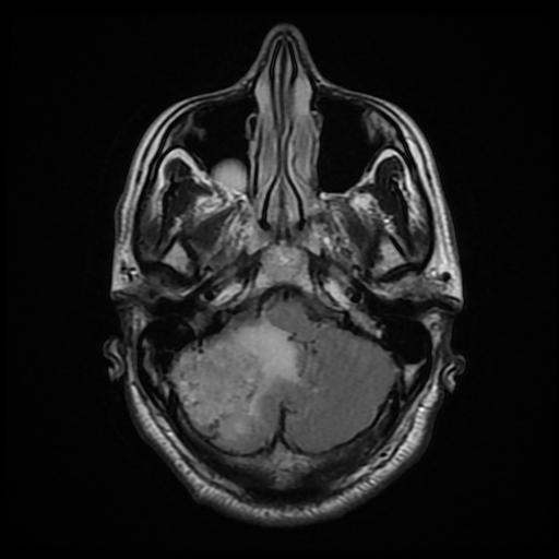File:Cerebellar hemangioblastoma (Radiopaedia 88055-104622 Axial FLAIR 8).jpg