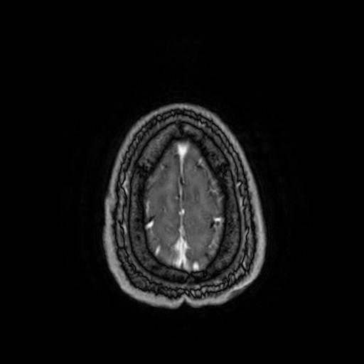 Cerebellar hemangioblastoma (Radiopaedia 88055-104622 Axial T1 C+ 158).jpg